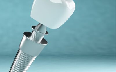 Why Dental Implants in Barranquilla, Colombia Are Gaining Global Attention